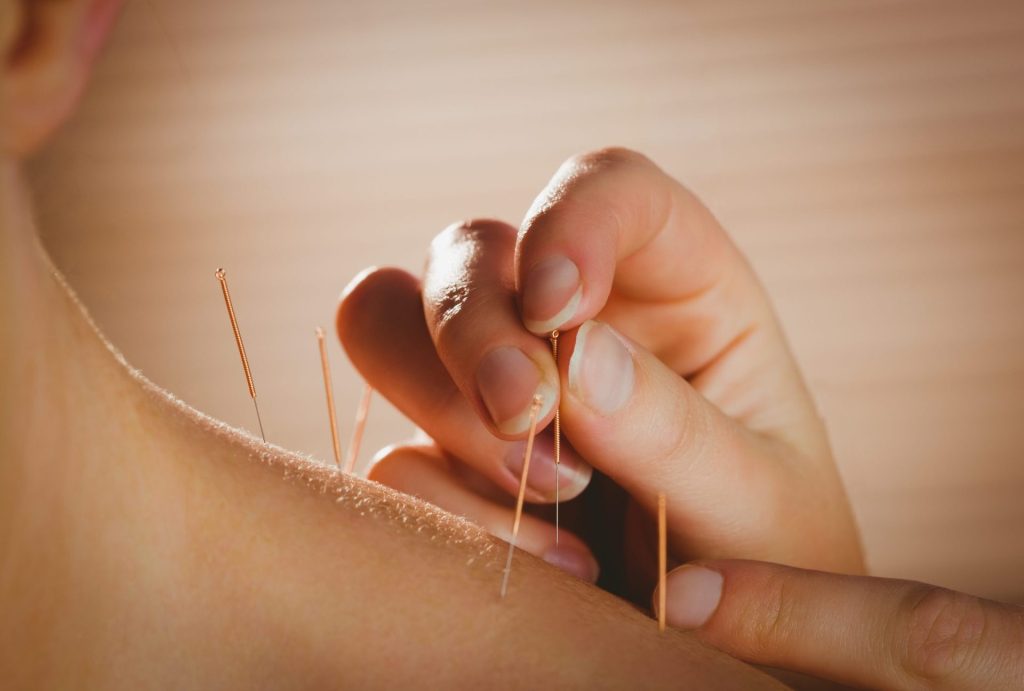 SS Acupuncture Heal Your Body with Ancient Chinese Therapy scaled 1