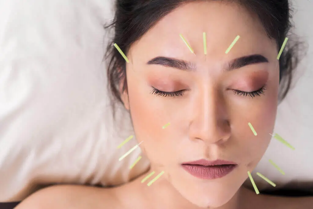 vhs acupuncture 1024x683 1 1.jpg